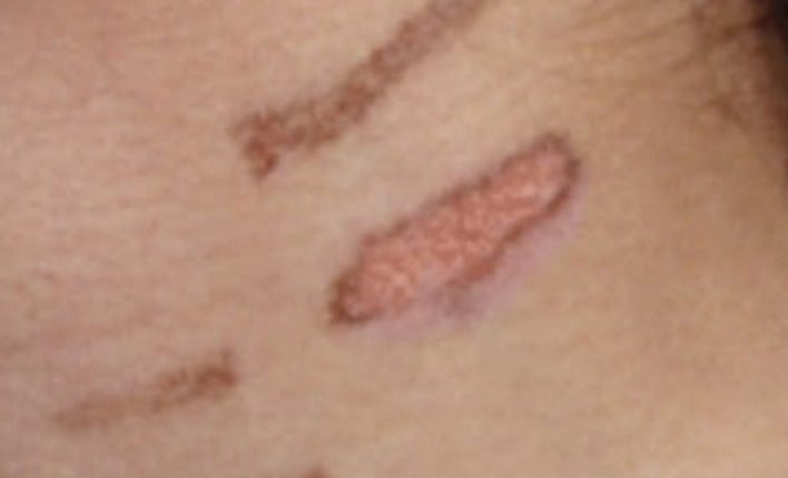Previous Burn Mark (Photo – AETOSWire)_1535281517